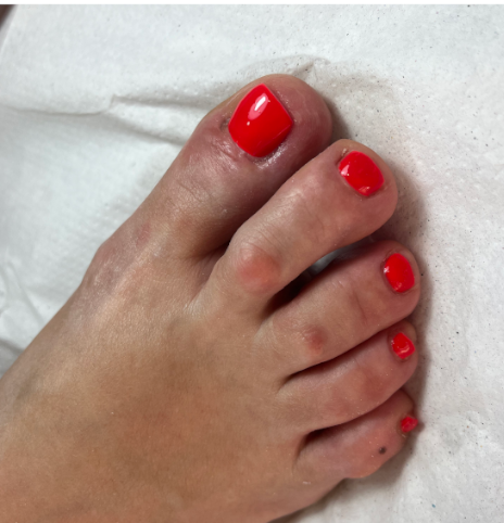 pedi 1
